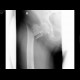 Pertrochanteric fracture of the femur: X-ray - Plain radiograph